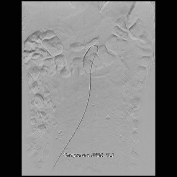 File:Abernethy malformation (Radiopaedia 42006-45462 Frontal Superior mesenteric artery 1).jpg