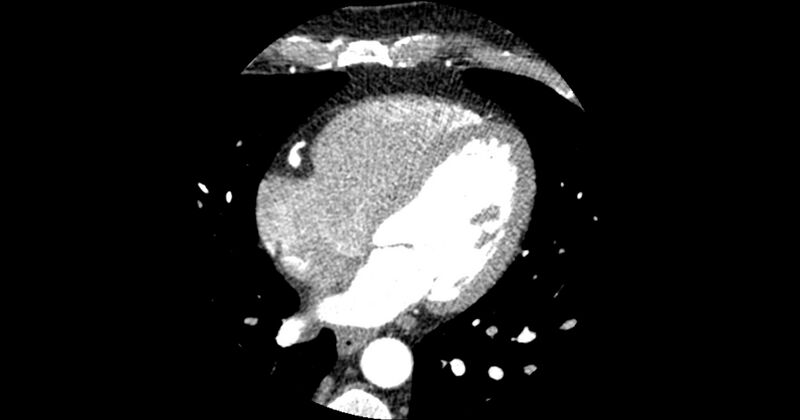 File:Aberrant left main coronary artery (ALMCA) arising from the right sinus with interarterial course (Radiopaedia 63251-71814 Axial C+ arterial phase 115).JPG
