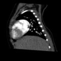 Aberrant left pulmonary artery (pulmonary sling) (Radiopaedia 42323-45435 Sagittal C+ arterial phase 14).jpg