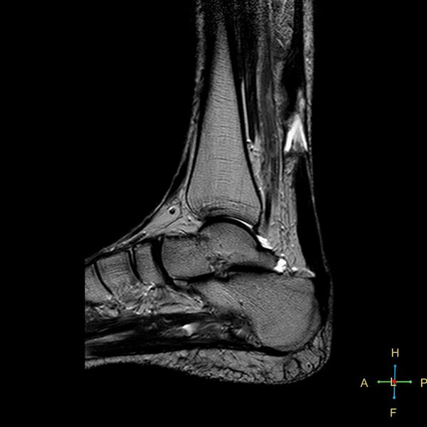 File:Achilles tendon complete tear (Radiopaedia 22834-22854 Sagittal T2 10).jpg