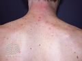 Acne affecting the back images (DermNet NZ acne-acne-back-178).jpg