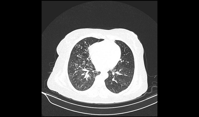 File:Acquired tracheo-esophageal fistula (Radiopaedia 51356-57103 Axial lung window 27).jpg