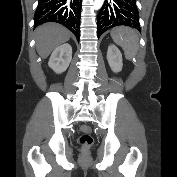 File:Active colonic bleed on CT (Radiopaedia 49765-55025 Coronal art MIP 45).jpg