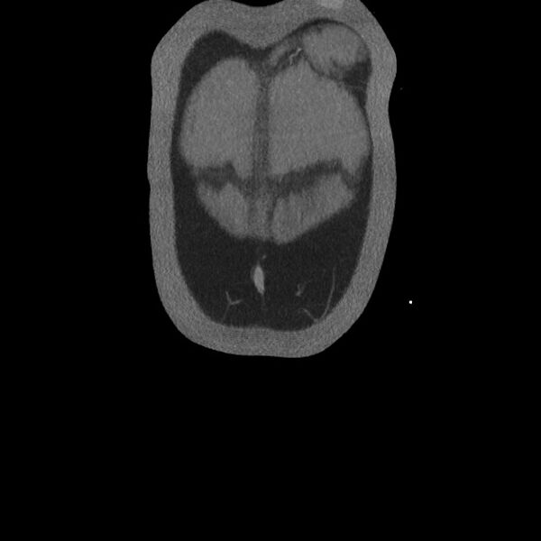 File:Active colonic bleed on CT (Radiopaedia 49765-55025 Coronal art MIP 8).jpg