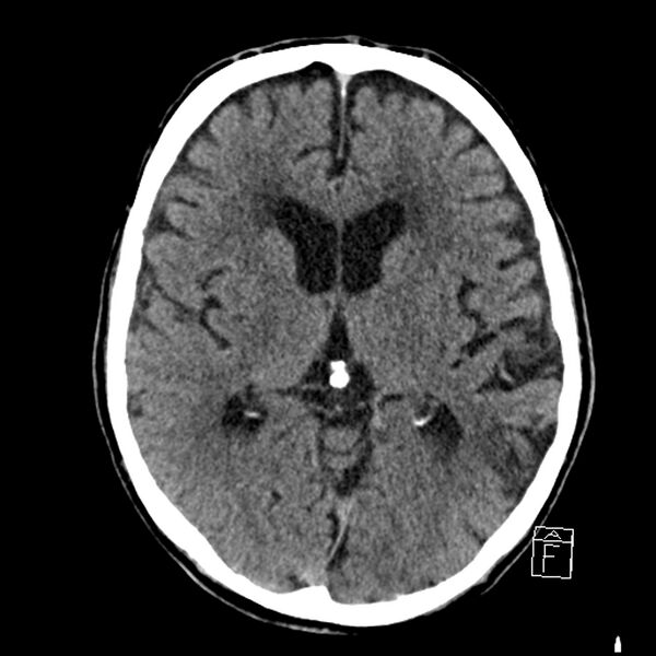 File:Acute P1 occlusion with PCA ischemia penumbra (CT perfusion) (Radiopaedia 72084-82586 Axial non-contrast 22).jpg