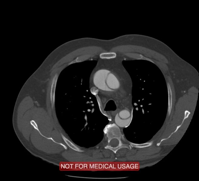 File:Acute aortic dissection - Stanford type A (Radiopaedia 40661-43285 Axial C+ arterial phase 14).jpg