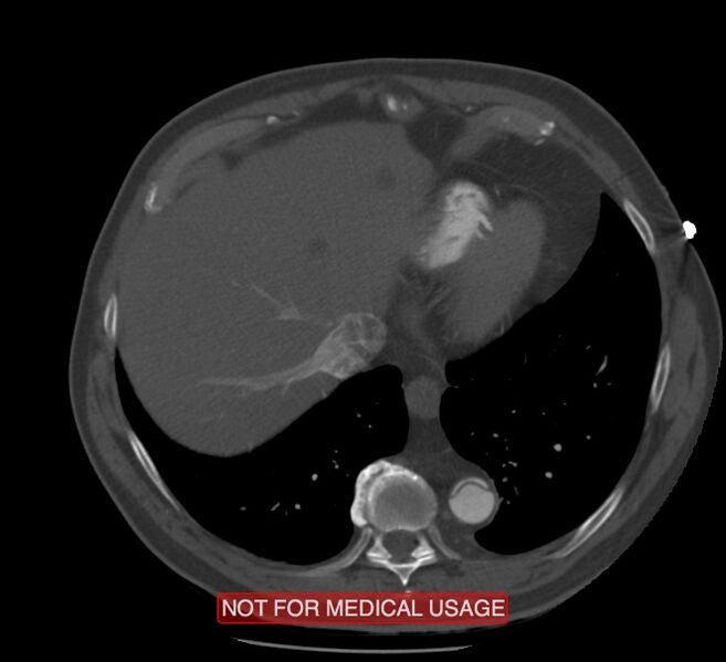 File:Acute aortic dissection - Stanford type A (Radiopaedia 40661-43285 Axial C+ arterial phase 60).jpg