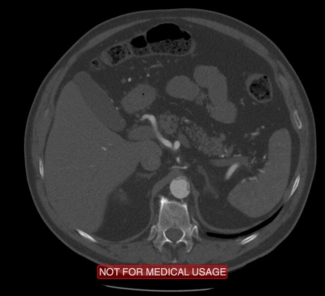File:Acute aortic dissection - Stanford type A (Radiopaedia 40661-43285 Axial C+ arterial phase 88).jpg