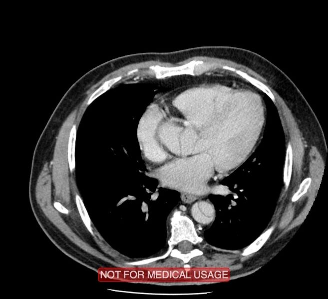 File:Acute aortic dissection - Stanford type A (Radiopaedia 40661-43285 Axial C+ portal venous phase 34).jpg