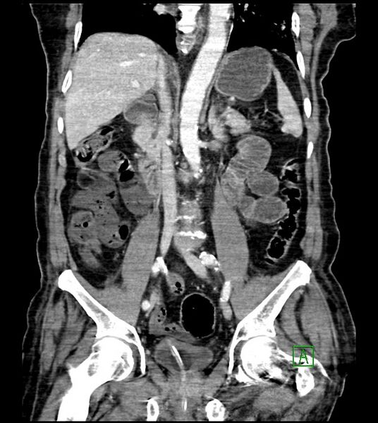 File:Acute arterial mesenteric ischemia (Radiopaedia 78238-90828 Coronal C+ portal venous phase 54).jpg