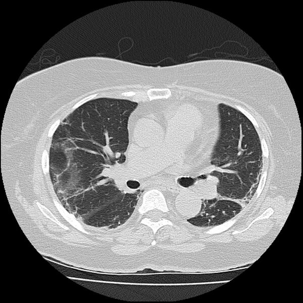 File:Acute interstitial pneumonitis (Radiopaedia 45404-49452 Axial lung window 45).jpg