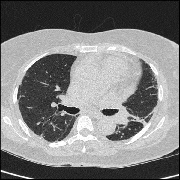 File:Acute interstitial pneumonitis (Radiopaedia 45404-49453 Axial lung window 40).jpg