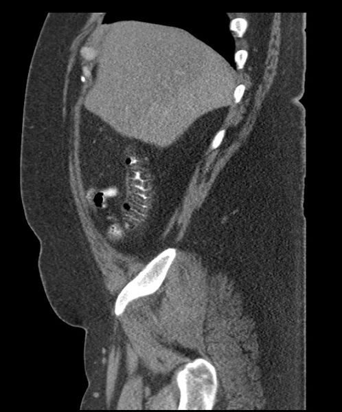 File:Acute mesenteric venous ischemia (Radiopaedia 46041-50383 Sagittal C+ portal venous phase 19).jpg