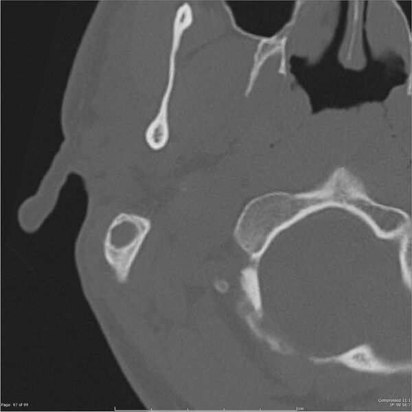 File:Acute otomastoiditis (Radiopaedia 28276-28512 Axial PTB bone window reformat 77).jpg