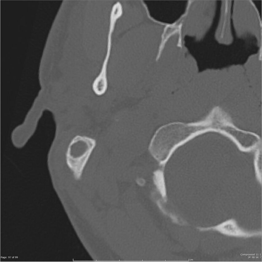 Acute otomastoiditis (Radiopaedia 28276-28512 Axial PTB bone window reformat 77).jpg