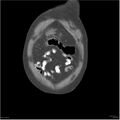 Acute pancreatitis (Radiopaedia 19135-19116 Coronal non-contrast 1).jpg