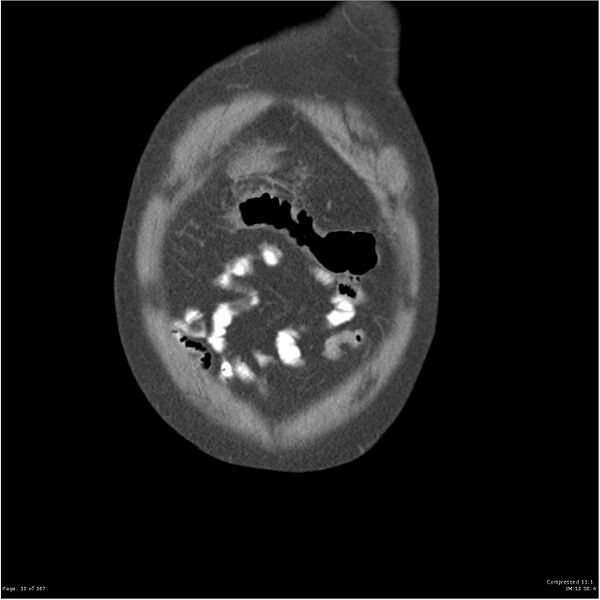 File:Acute pancreatitis (Radiopaedia 19135-19116 Coronal non-contrast 1).jpg
