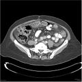 Acute pancreatitis (Radiopaedia 19136-19117 Axial C+ portal venous phase 29).jpg
