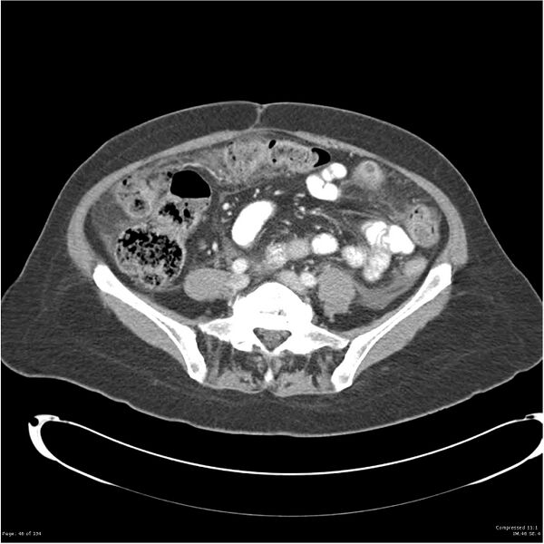 File:Acute pancreatitis (Radiopaedia 19136-19117 Axial C+ portal venous phase 29).jpg