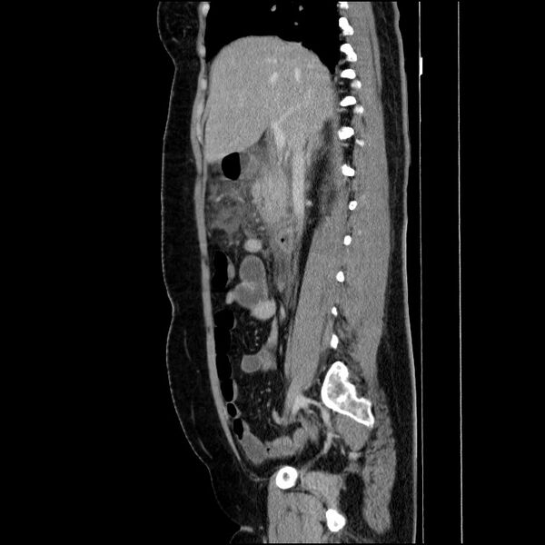 File:Acute pancreatitis (Radiopaedia 69236-79012 Sagittal C+ portal venous phase 62).jpg