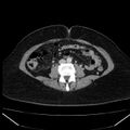 Acute pancreatitis - Balthazar C (Radiopaedia 26569-26714 Axial C+ portal venous phase 58).jpg