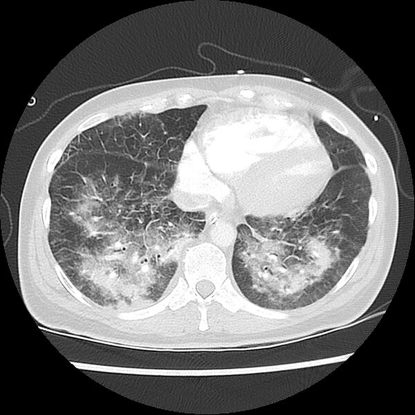 File:Acute pulmonary edema on CT (Radiopaedia 33582-34672 Axial lung window 40).jpg