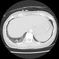 Acute pulmonary edema on CT (Radiopaedia 33582-34672 Axial lung window 48).jpg