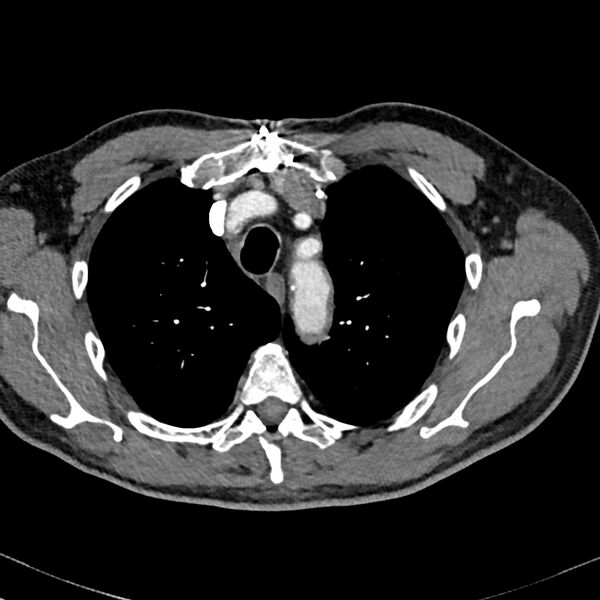 File:Acute pulmonary embolism (Radiopaedia 81677-95570 Axial C+ CTPA 4).jpg