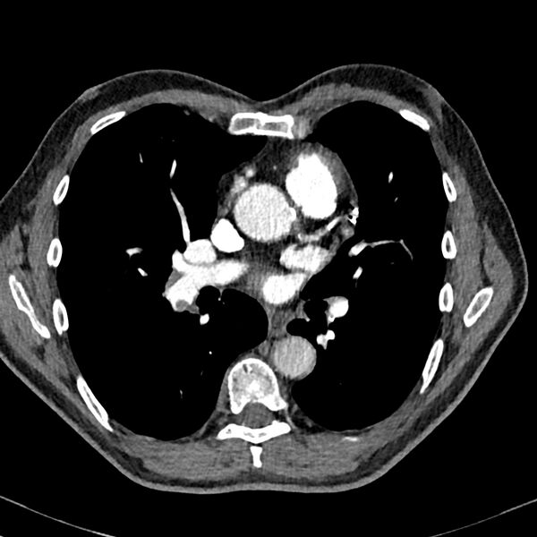 File:Acute pulmonary embolism (Radiopaedia 81677-95570 Axial C+ CTPA 52).jpg