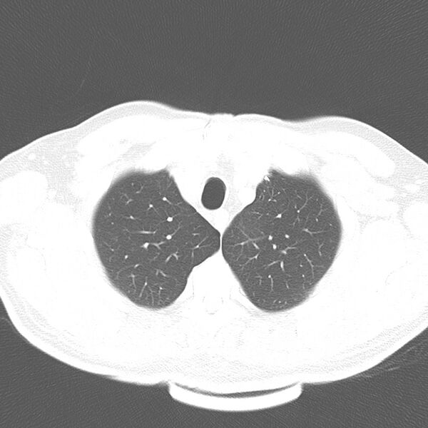 File:Acute pulmonary embolism (Radiopaedia 81677-95570 Axial lung window 7).jpg