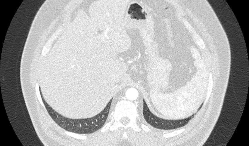 Acute pulmonary embolism with pulmonary infarcts (Radiopaedia 77688-89908 Axial lung window 130).jpg