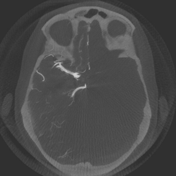 File:Acute subarachnoid hemorrhage and accessory anterior cerebral artery (Radiopaedia 69231-79010 Axial arterial - MIP 29).jpg