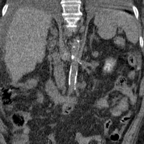 File:Acute tubular necrosis (Radiopaedia 28077-28334 Coronal non-contrast 4).jpg