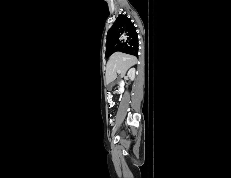 File:Addison disease (Radiopaedia 49318-54412 Sagittal C+ portal venous phase 45).jpg