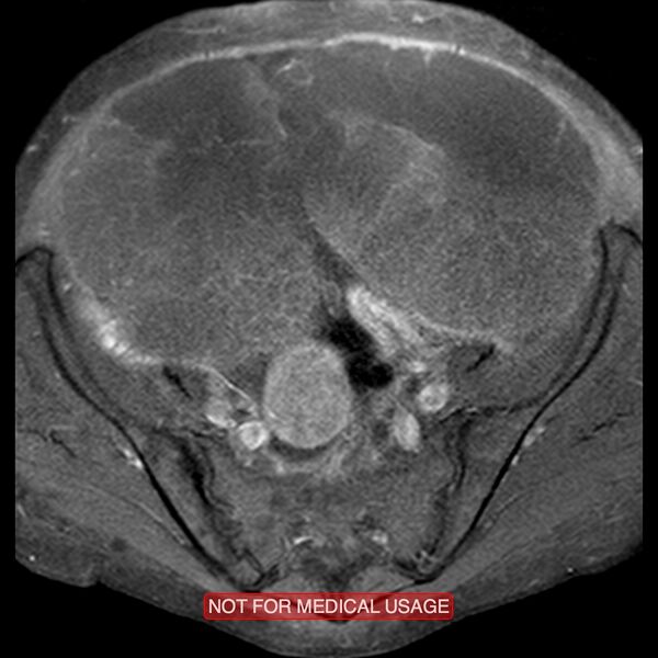 File:Adenocarcinoma of the cervix (Radiopaedia 28373-28615 Axial T1 C+ fat sat 19).jpg