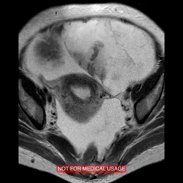 File:Adenocarcinoma of the cervix (Radiopaedia 28373-28615 Axial T2 14).jpg