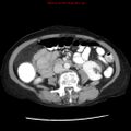 Adenocarcinoma of the colon (Radiopaedia 8191-9039 Axial liver window 38).jpg