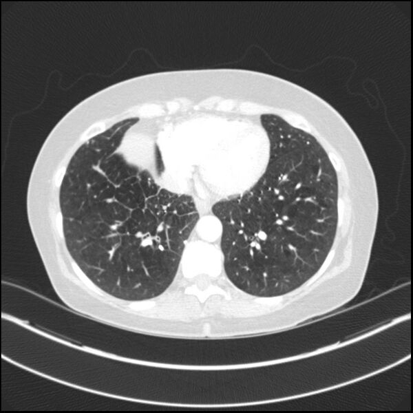 File:Adenocarcinoma of the lung (Radiopaedia 44205-47803 Axial lung window 66).jpg