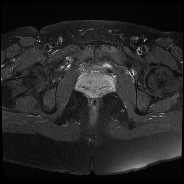 File:Adenomyosis-scar endometriosis (Radiopaedia 65863-75022 Axial T1 C+ fat sat 22).jpg