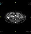 Adenomyosis (Radiopaedia 43504-46889 Axial 2D FIESTA 27).jpg