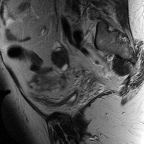 File:Adenomyosis of the uterus (Radiopaedia 9869-10437 Sagittal T2 1).jpg