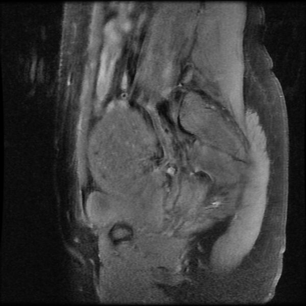 File:Adenomyosis on MRI (Radiopaedia 29328-29780 Sagittal T1 fat sat 3).jpg