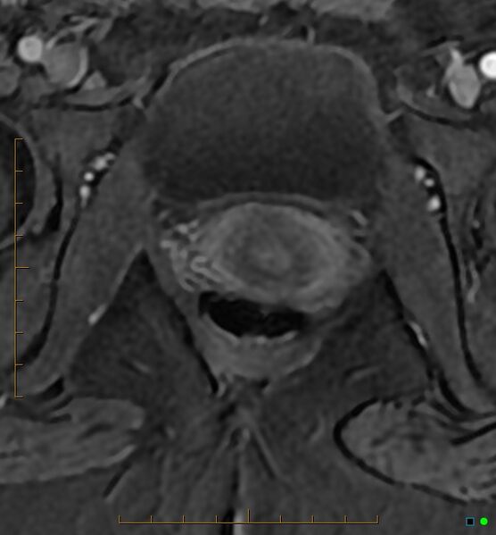 File:Adenomyosis uterus with hematometra (Radiopaedia 45779-50011 Axial T1 C+ fat sat 62).jpg