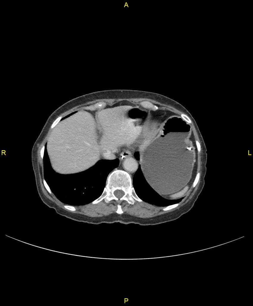Adhesional small bowel obstruction (Radiopaedia 85402-101024 Axial C+ portal venous phase 39).jpg