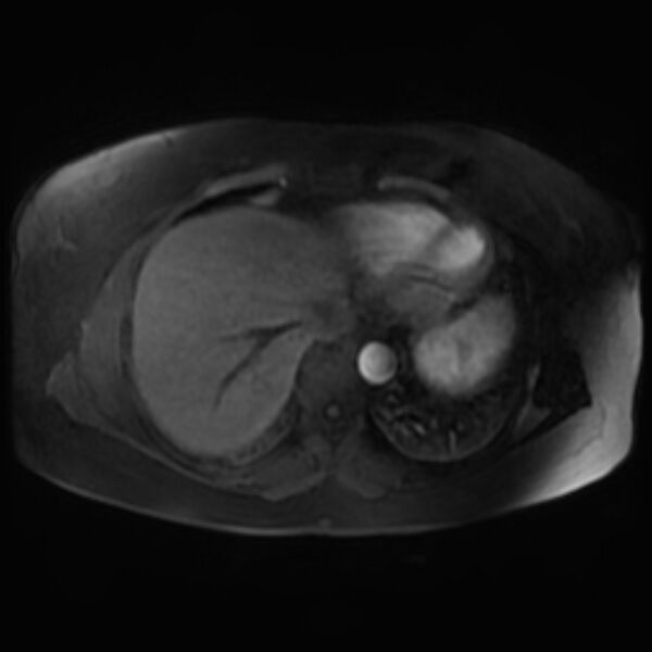 File:Adrenal cortical carcinoma (Radiopaedia 70906-81116 Axial Postcontrast-Dyn T1 fat sat 4).jpg