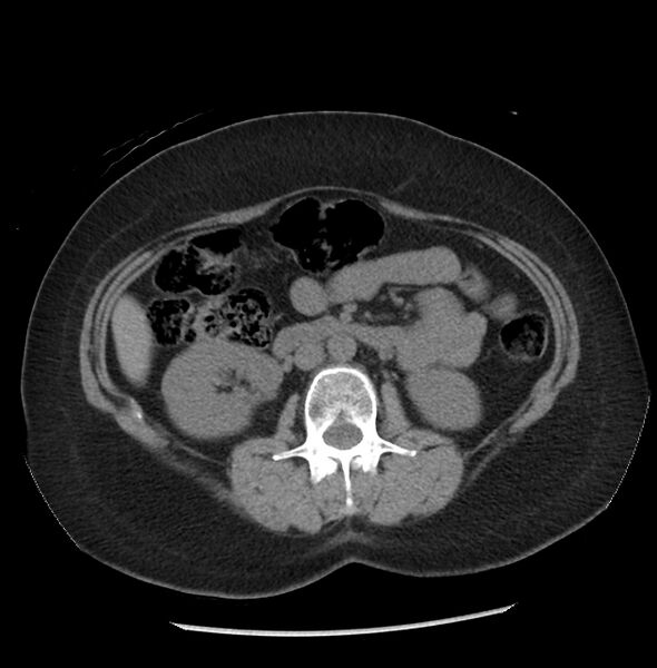 File:Adrenal cortical carcinoma with IVC invasion and thrombosis (Radiopaedia 34307-35597 Axial non-contrast 29).jpg