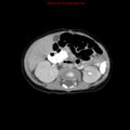 Adrenal hemorrhage (Radiopaedia 9390-10077 Axial C+ portal venous phase 16).jpg