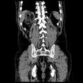 Adrenal myelolipoma (Radiopaedia 41843-44834 Coronal non-contrast 20).jpg