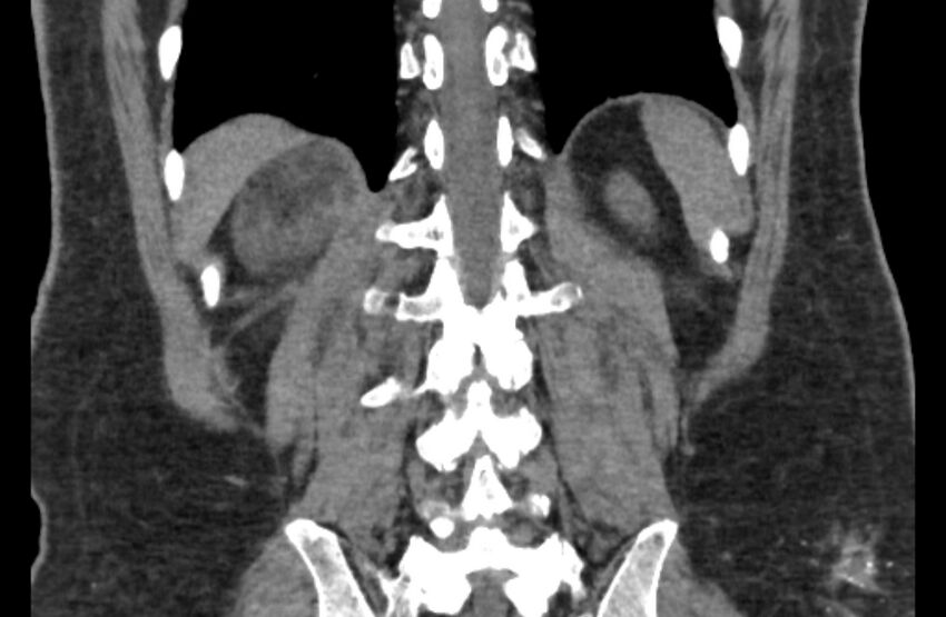 Adrenal myelolipoma (Radiopaedia 65240-74253 Coronal non-contrast 59).jpg