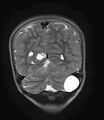 Aicardi syndrome (Radiopaedia 66029-75205 Coronal T2 21).jpg